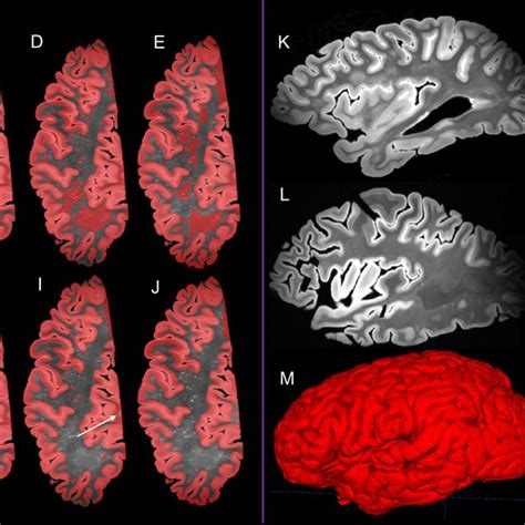 cortical thickness measurement|cortical thickness brain meaning.